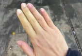 雷诺综合征挂什么科，雷诺综合征挂什么科室