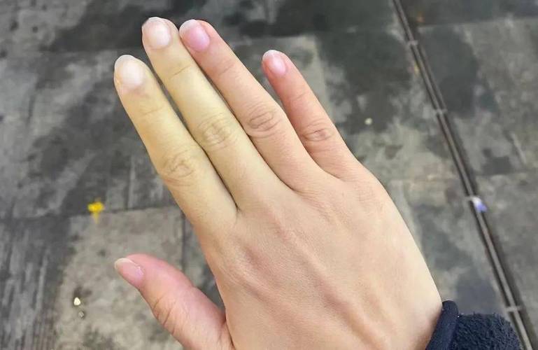 雷诺综合征挂什么科，雷诺综合征挂什么科室  第1张