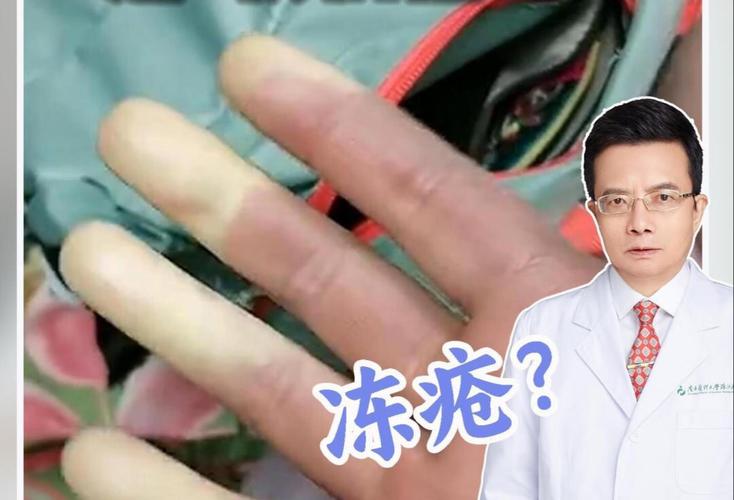雷诺综合征挂什么科，雷诺综合征挂什么科室  第4张
