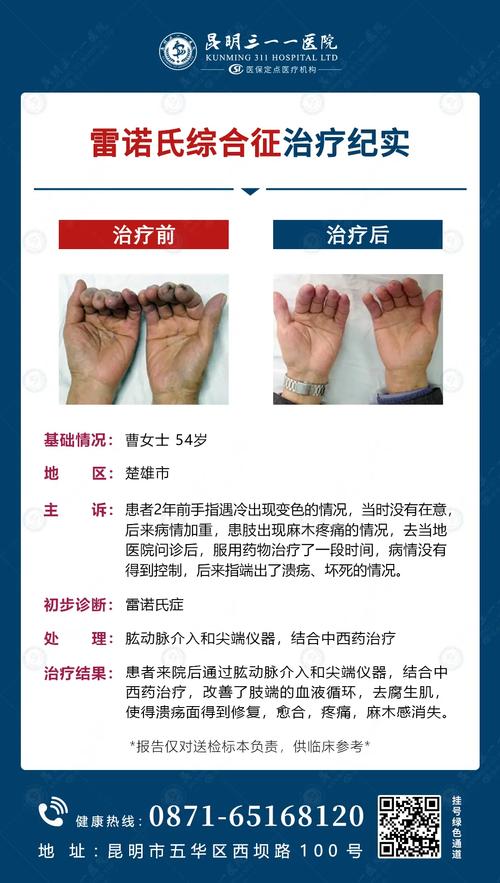 雷诺综合症能治好吗，雷诺综合症能治好吗女性  第2张